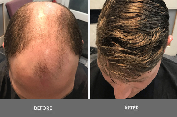 Can I Get a Hair Transplant Without Surgery?