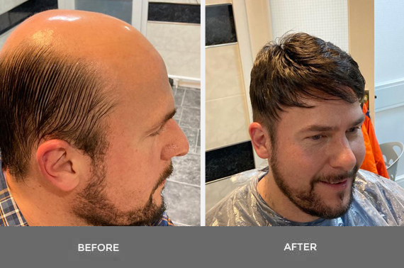 Is There a Permanent Non-Surgical Hair Transplant?