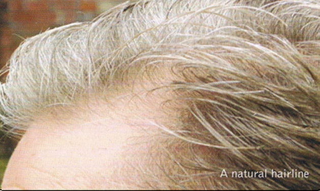 Can hair grow back after Balding?