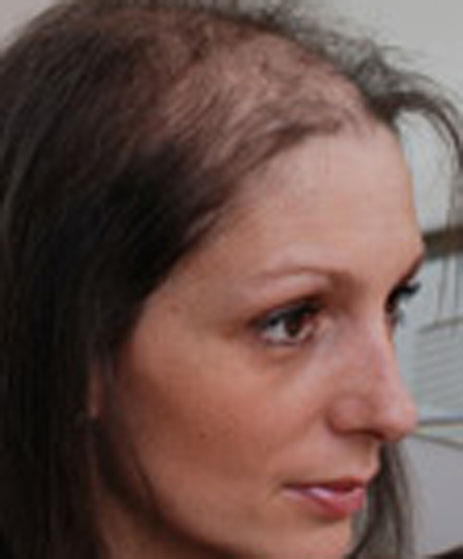 femail hair loss