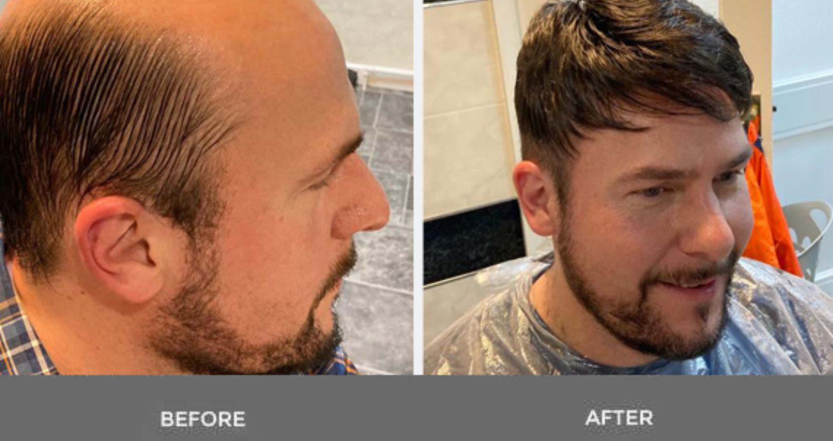 Hair Replacement