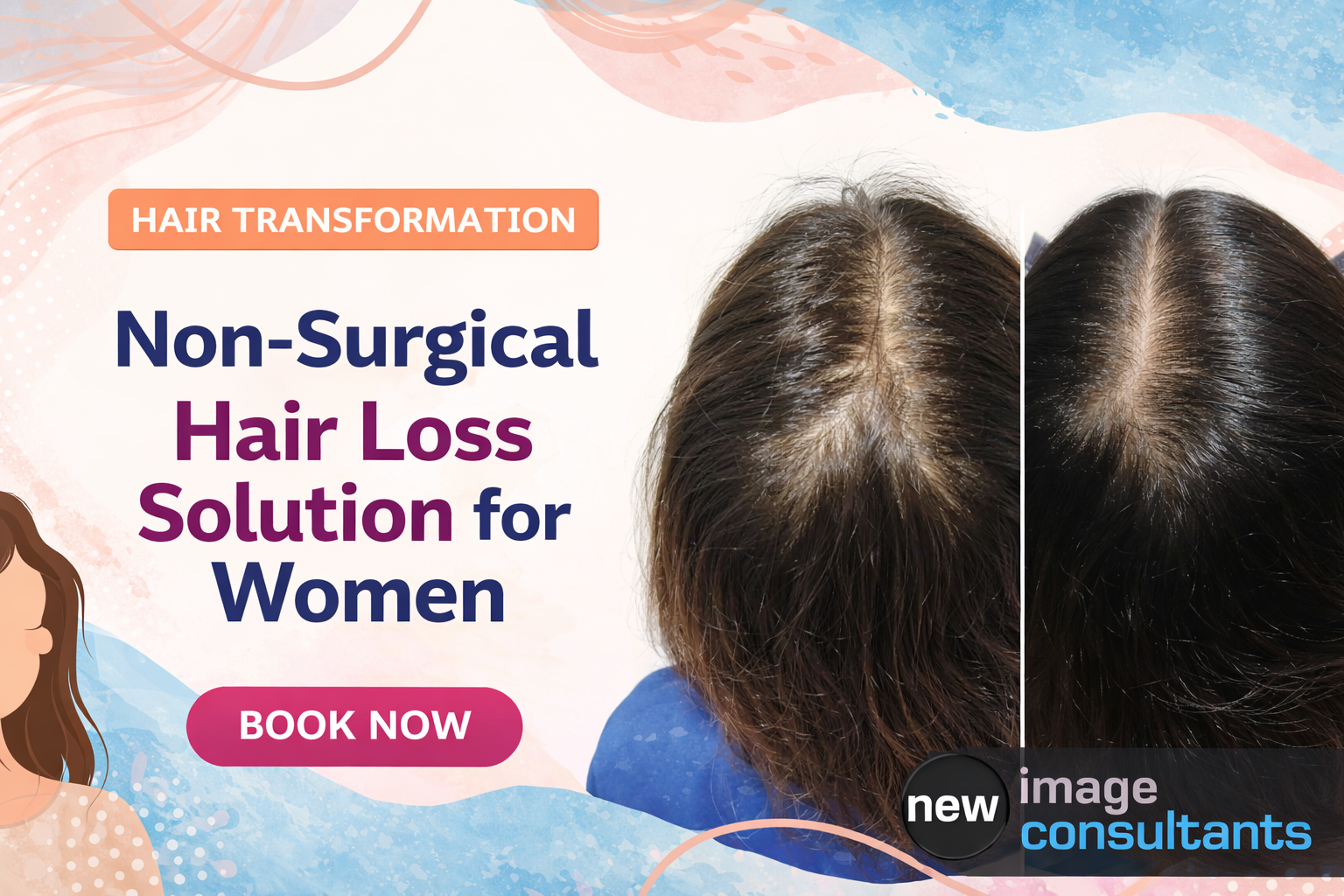 Non-Surgical Hair Loss Solution for Women