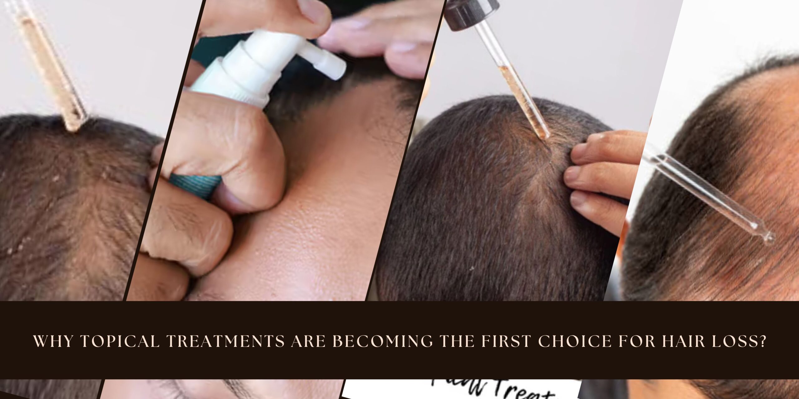 Topical Treatments for Hair Loss