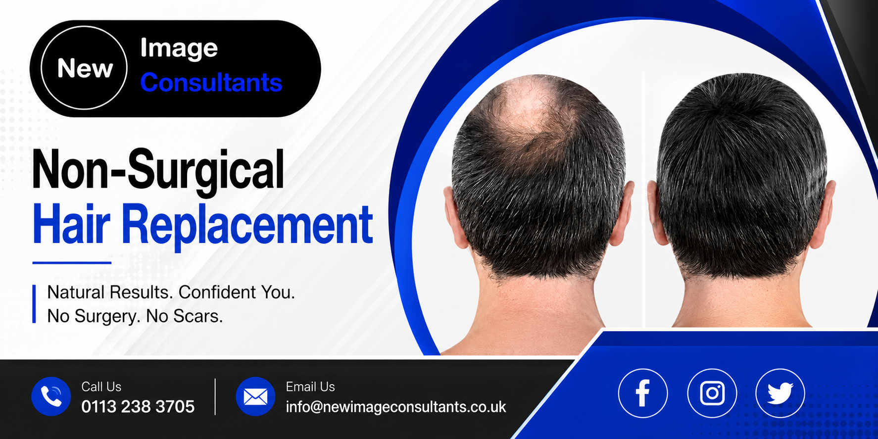 Non-Surgical Hair Replacement
