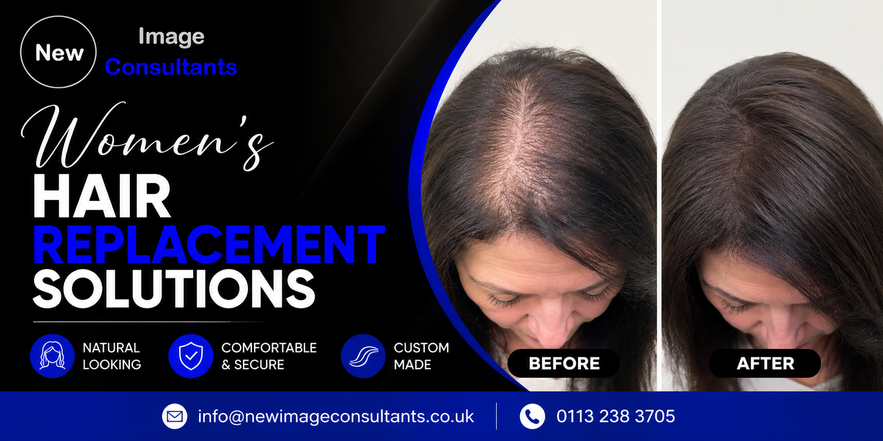 Hair Replacement for Women