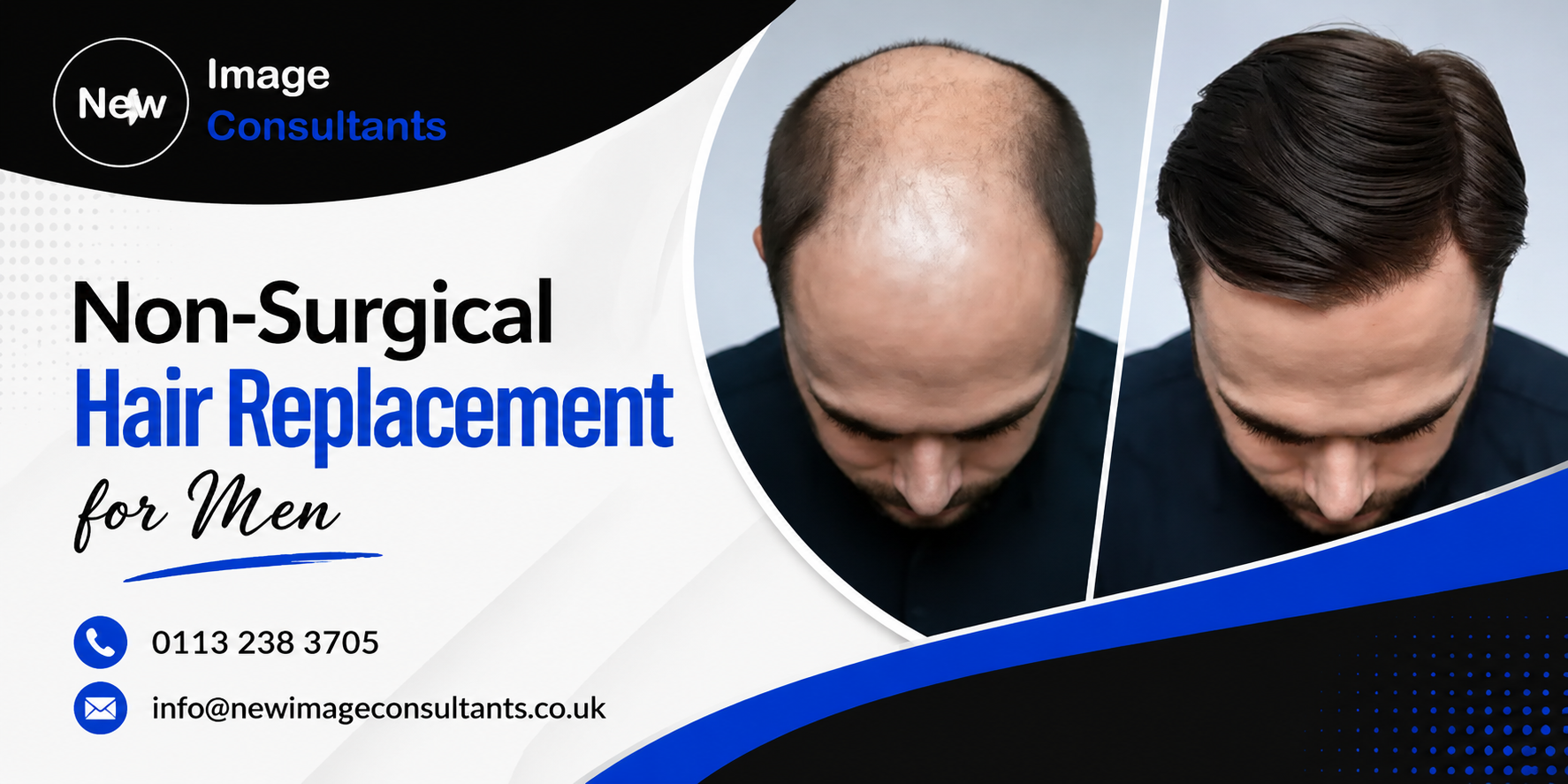Hair Replacement