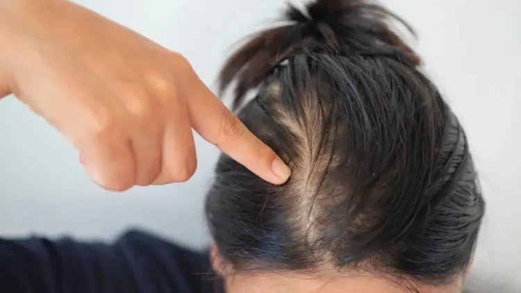 hair loss consultation Leeds