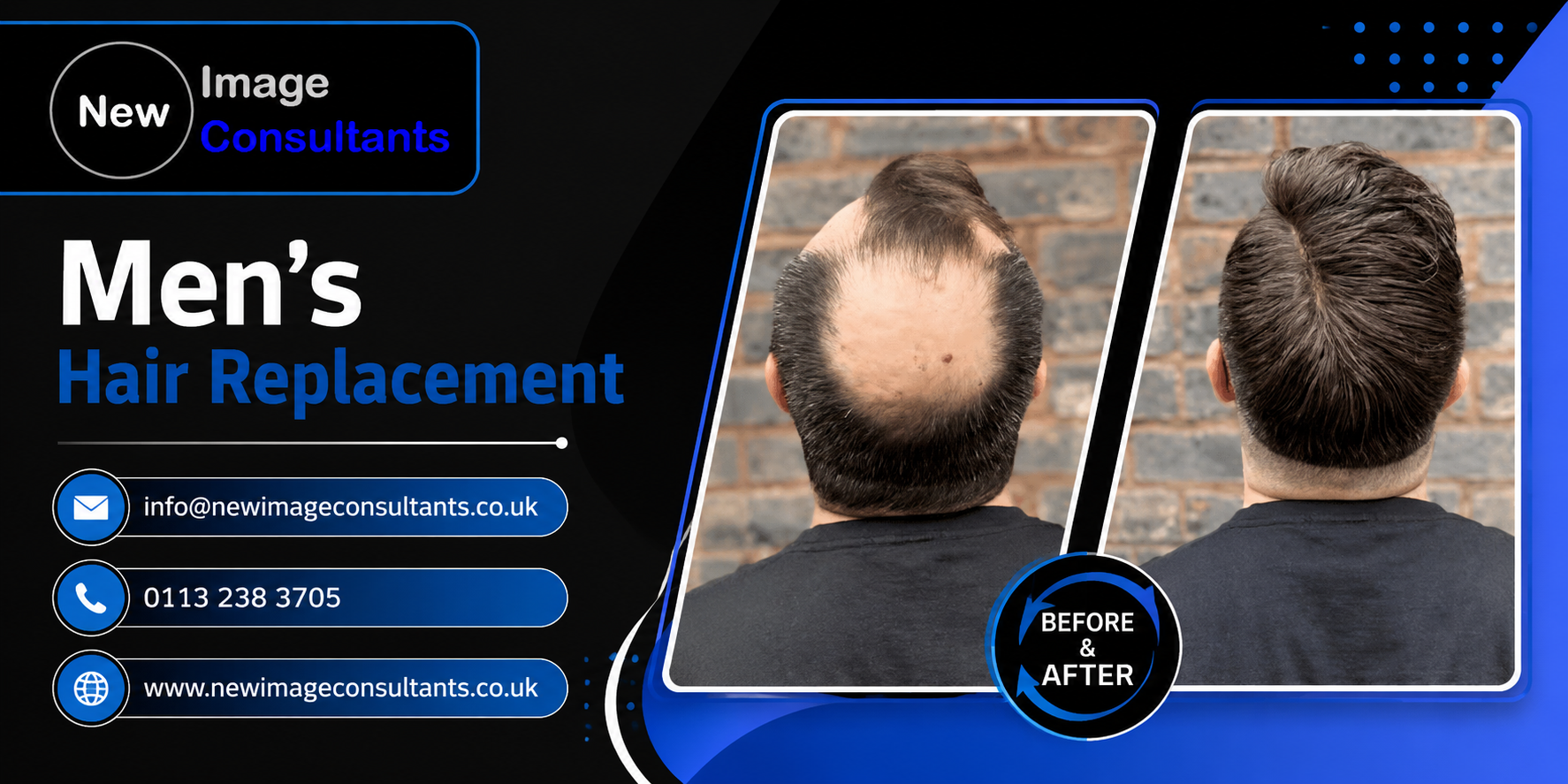 Men&rsquo;s Hair Replacement
